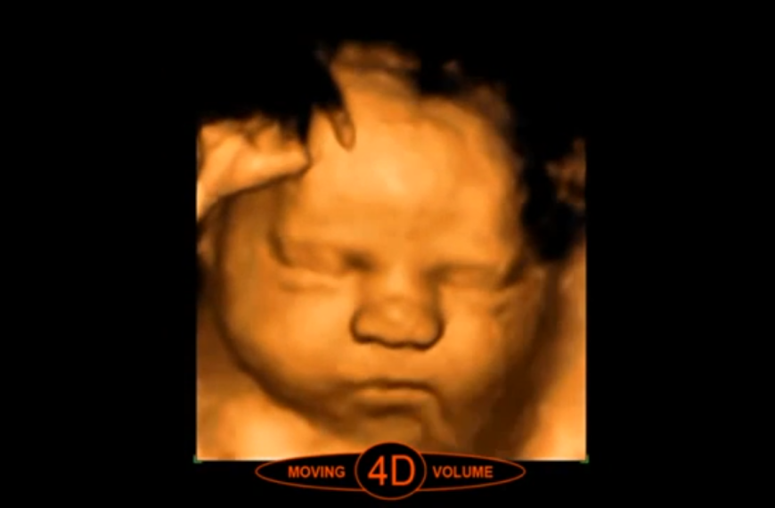 Diferencias entre Eco 2D y…